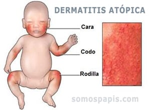 dermatitis atópica en niños