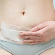 Cicatriz cesárea: cuidados y recomendaciones para una óptima recuperación
