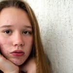 Adolescencia y Acné: lo que nadie te cuenta y todo padre debería saber