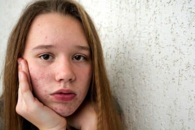 Adolescencia y Acné: lo que nadie te cuenta y todo padre debería saber